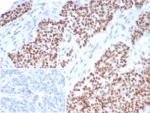 IHC staining of FFPE human ovarian carcinoma tissue with recombinant p53 antibody (clone TP53/7082R). Inset: PBS used in place of primary Ab (secondary Ab negative control). HIER: boil tissue sections in pH 9 10mM Tris with 1mM EDTA for 20 min and allow to cool before testing.
