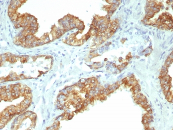 IHC staining of FFPE human prostate cancer tissue with recombinant CK19 antibody (clone KRT19/8091R). HIER: boil tissue sections in pH 9 10mM Tris with 1mM EDTA for 20 min and allow to cool before testing.~