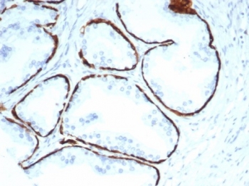 IHC staining of FFPE human prostate tissue with recombinant Cytokeratin 14 antibody (clone KRT14/7054R). HIER: boil tissue sections in pH 9 10mM Tris with 1mM EDTA for 20 min and allow to cool before testing.~