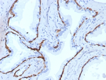 IHC staining of FFPE human prostate tissue with recombinant Keratin 14 antibody (clone KRT14/7977R). HIER: boil tissue sections in pH 9 10mM Tris with 1mM EDTA for 20 min and allow to cool before testing.~