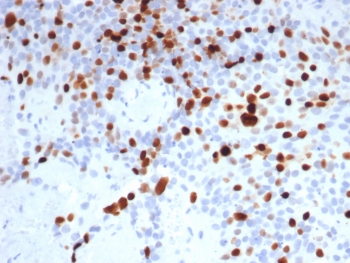 IHC staining of FFPE human lymph node tissue with Topoisomerase II alpha antibody (clone TOP2A/8103R). HIER: boil tissue sections in pH 9 10mM Tris with 1mM EDTA for 20 min and allow to cool before testing.~