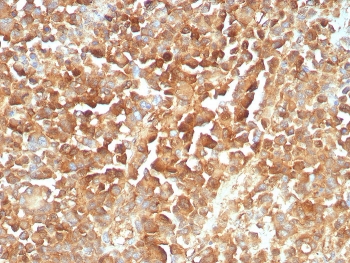 IHC staining of FFPE human melanoma tissue with recombinant NGFR antibody (clone rNGFR/8824). HIER: boil tissue sections in pH 9 10mM Tris with 1mM EDTA for 20 min and allow to cool before testing.~