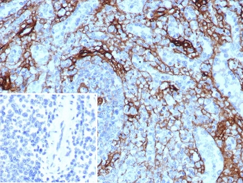 IHC staining of FFPE human spleen tissue with CD271 antibody (clone NGFR/8590R). Inset: PBS used in place of primary Ab (secondary Ab negative control). HIER: boil tissue sections in pH 9 10mM Tris with 1mM EDTA for 20 min and allow to cool before testing.~