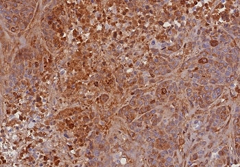 IHC staining of FFPE human bladder carcinoma tissue with TIMP2 antibody (clone TIMP2/8193R). HIER: boil tissue sections in pH 9 10mM Tris with 1mM EDTA for 20 min and allow to cool before testing.~