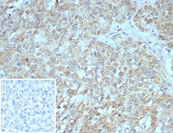 IHC staining of FFPE human pancreas tissue with SSTR2 antibody (clone SSTR2/7532). Inset: PBS used in place of primary Ab (secondary Ab negative control). HIER: boil tissue sections in pH 9 10mM Tris with 1mM EDTA for 20 min and allow to cool before testing.~