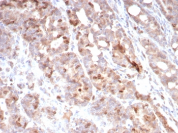 IHC staining of FFPE human colon carcinoma tissue with Survivin antibody (clone BIRC5/7775). HIER: boil tissue sections in pH 9 10mM Tris with 1mM EDTA for 20 min and allow to cool before testing.~