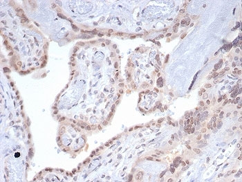 IHC staining of FFPE human pancreas tissue with SMAD4 antibody (clone SMAD4/7901). HIER: boil tissue sections in pH 9 10mM Tris with 1mM EDTA for 20 min and allow to cool before testing.~