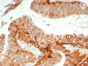 IHC staining of FFPE human colon carcinoma tissue with CD147 antibody (clone BSG/7954) at 2ug/ml. HIER: boil tissue sections in pH 9 10mM Tris with 1mM EDTA for 20 min and allow to cool before testing.