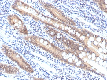 IHC staining of FFPE human pancreatic carcinoma tissue with recombinant SMAD4 antibody (clone SMAD4/7906R). HIER: boil tissue sections in pH 9 10mM Tris with 1mM EDTA for 20 min and allow to cool before testing.~