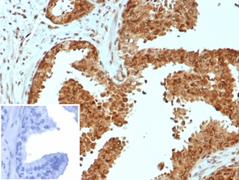 IHC staining of FFPE human prostate carcinoma tissue with CARM1 antibody (clone CARM1/7426). Inset: PBS used in place of primary Ab (secondary Ab negative control). HIER: boil tissue sections in pH 9 10mM Tris with 1mM EDTA for 20 min and allow to cool before testing.~