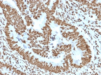 IHC staining of FFPE human colon carcinoma tissue with ZNF690 / ZSCAN29 antibody (clone PCRP-ZNF846-1E12). HIER: boil tissue sections in pH 9 10mM Tris with 1mM EDTA for 20 min and allow to cool before testing.~