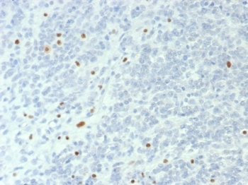 IHC staining of FFPE human ovarian small cell carcinoma with SMARCA4 antibody (clone BRG1/6531R). HIER: boil tissue sections in pH 9 10mM Tris with 1mM EDTA for 20 min and allow to cool before testing.~