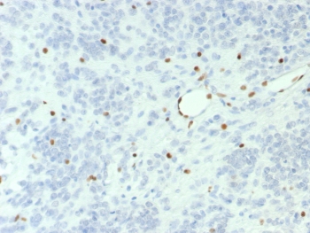 IHC staining of FFPE human ovarian small cell carcinoma with BRG1 antibody (clone BRG1/7633R). HIER: boil tissue sections in pH 9 10mM Tris with 1mM EDTA for 20 min and allow to cool before testing.~