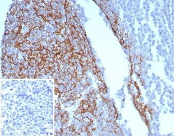IHC staining of FFPE human tonsil tissue with CD23 antibody (clone FCER2/8234R). Inset: PBS used in place of primary Ab (secondary Ab negative control). HIER: boil tissue sections in pH 9 10mM Tris with 1mM EDTA for 20 min and allow to cool before testing.~