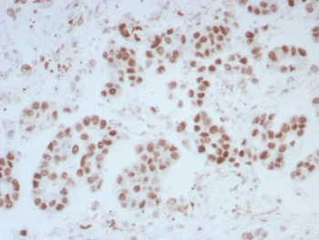 IHC staining of FFPE human bladder tissue with ERCC1 antibody (clone ERCC1/7597). HIER: boil tissue sections in pH 9 10mM Tris with 1mM EDTA for 20 min and allow to cool before testing.~