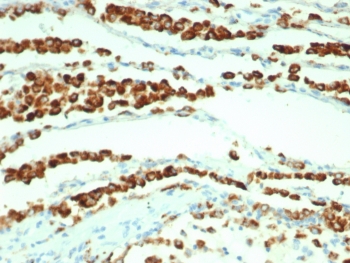 IHC staining of FFPE human lung adenocarcinoma tissue with recombinant NAPSA antibody antibody (clone rNAPSA/7239) at 2ug/ml. HIER: boil tissue sections in pH 9 10mM Tris with 1mM EDTA for 20 min and allow to cool before testing.~