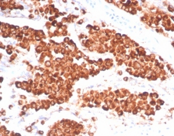IHC staining of FFPE human lung adenocarcinoma tissue with NAPSA antibody (clone NAPSA/7165R) at 2ug/ml. HIER: boil tissue sections in pH 9 10mM Tris with 1mM EDTA for 20 min and allow to cool before testing.~