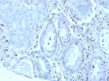 IHC staining of FFPE human colon carcinoma tissue with Myeloid zinc finger 1 antibody (clone PCRP-MZF1-1E8). HIER: boil tissue sections in pH 9 10mM Tris with 1mM EDTA for 20 min and allow to cool before testing.~
