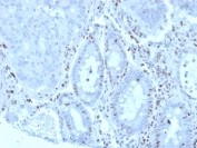 IHC staining of FFPE human colon carcinoma tissue with Myeloid zinc finger 1 antibody (clone PCRP-MZF1-1E8). HIER: boil tissue sections in pH 9 10mM Tris with 1mM EDTA for 20 min and allow to cool before testing.