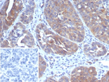IHC staining of FFPE human ovarian cancer tissue with GLCLR antibody (clone GCLM/4069). Inset: PBS used in place of primary Ab (secondary Ab negative control). HIER: boil tissue sections in pH 9 10mM Tris with 1mM EDTA for 20 min and allow to cool before testing.~