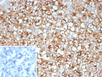 IHC staining of FFPE human renal cell carcinoma tissue with Op18 antibody (clone STMN1/8438). Inset: PBS used in place of primary Ab (secondary Ab negative control). HIER: boil tissue sections in pH 9 10mM Tris with 1mM EDTA for 20 min and allow to cool before testing.~