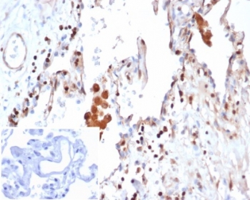 IHC staining of FFPE human lung adenocarcinoma tissue