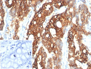 IHC staining of FFPE human colon carcinoma tissue with S100A14 antibody (clone S100A14/7401). Inset: PBS used in place of primary Ab (secondary Ab negative control). HIER: boil tissue sections in pH 9 10mM Tris with 1mM EDTA for 20 min and allow to cool before testing.~
