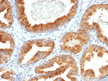 IHC staining of FFPE human prostate cancer tissue with CREB3L4 antibody (clone PCRP-CREB3L4-1A3). HIER: boil tissue sections in pH 9 10mM Tris with 1mM EDTA for 20 min and allow to cool before testing.~