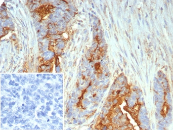 IHC staining of FFPE human ovarian cancer tissue with Mucin 1 antibody (clone MUC1/7797R). Inset: PBS used in place of primary Ab (secondary Ab negative control). HIER: boil tissue sections in pH 9 10mM Tris with 1mM EDTA for 20 min and allow to cool before testing.~
