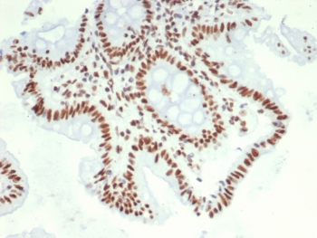 IHC staining of FFPE human colon carcinoma tissue