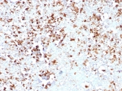 IHC staining of FFPE human colon carcinoma tissue with Myelin Protein Zero antibody (clone MPZ/7389). HIER: boil tissue sections in pH 9 10mM Tris with 1mM EDTA for 20 min and allow to cool before testing.
