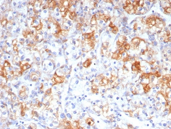 IHC staining of FFPE human renal cell carcinoma tissue with COX2 antibody (clone rCOX2/6996). HIER: boil tissue sections in pH 9 10mM Tris with 1mM EDTA for 20 min and allow to cool before testing.~