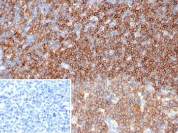IHC staining of FFPE human tonsil tissue with CD45 antibody (clone PTPRC/6862). Inset: PBS used in place of primary Ab (secondary Ab negative control). HIER: boil tissue sections in pH 9 10mM Tris with 1mM EDTA for 20 min and allow to cool before testing.~