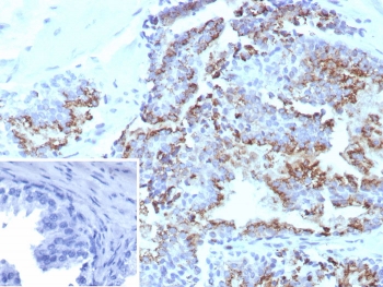IHC staining of FFPE human prostate tissue with Prostein antibody (clone SLC45A3/7648). Inset: PBS used in place of primary Ab (secondary Ab negative control). HIER: boil tissue sections in pH 9 10mM Tris with 1mM EDTA for 20 min and allow to cool before testing.~