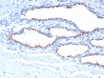 IHC staining of FFPE human prostate tissue with SLC45A3 antibody (clone SLC45A3/7653). HIER: boil tissue sections in pH 9 10mM Tris with 1mM EDTA for 20 min and allow to cool before testing.~