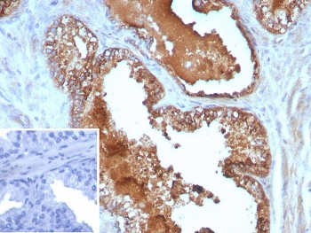 IHC staining of FFPE human prostate cancer tissue with Interleukin 10 antibody (clone IL10/8711). Inset: PBS used in place of primary Ab (secondary Ab negative control). HIER: boil tissue sections in pH 9 10mM Tris with 1mM EDTA for 20 min and allow to cool before testing.~