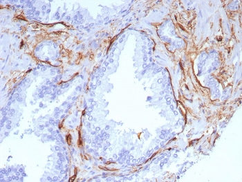 IHC staining of FFPE human colon cancer tissue with CD34 antibody (clone rHPCA1/8573). HIER: boil tissue sections in pH 9 10mM Tris with 1mM EDTA for 20 min and allow to cool before testing.~
