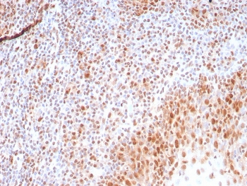 IHC staining of FFPE human tonsil tissue with recombinant PCNA antibody (clone rPCNA/8858) at 2ug/ml. HIER: boil tissue sections in pH 9 10mM Tris with 1mM EDTA for 20 min and allow to cool before testing.~