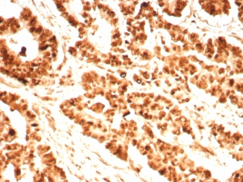 IHC staining of FFPE human prostate tissue with PCNA antibody (clone PCNA/8696R). Inset: PBS used in place of primary Ab (secondary Ab negative control). HIER: boil tissue sections in pH 9 10mM Tris with 1mM EDTA for 20 min and allow to cool before testing.~