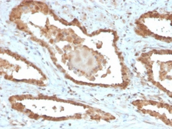 IHC staining of FFPE human prostate tissue with MIF antibody (clone MIF/6277). HIER: boil tissue sections in pH 9 10mM Tris with 1mM EDTA for 20 min and allow to cool before testing.~
