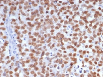 IHC staining of FFPE human seminoma tissue with