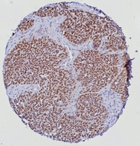 IHC staining of FFPE human prostate tissue with ETS-related gene antibody (clone ERG/6980) at 2ug/ml. HIER: boil tissue sections in pH 9 10mM Tris with 1mM EDTA for 20 min and allow to cool before testing.~