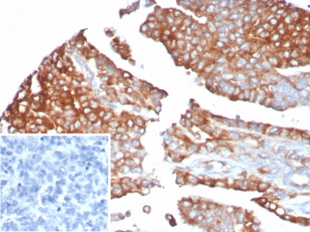 IHC staining of FFPE human ovarian cancer tissue with MX1 antibody (clone MX1/7527). Inset: PBS used in place of primary Ab (secondary Ab negative control). HIER: boil tissue sections in pH 9 10mM Tris with 1mM EDTA for 20 min and allow to cool before testing.~
