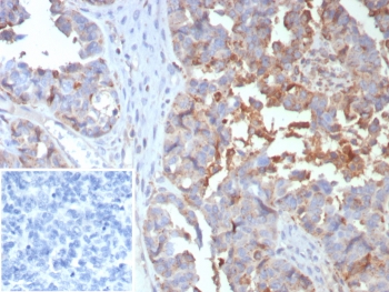 IHC staining of FFPE human ovarian cancer tissue with MX1 antibody (clone MX1/7529). Inset: PBS used in place of primary Ab (secondary Ab negative control). HIER: boil tissue sections in pH 9 10mM Tris with 1mM EDTA for 20 min and allow to cool before testing.~