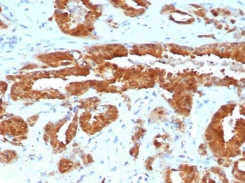 IHC staining of FFPE human prostate tissue with MIF antibody (clone MIF/6282). HIER: boil tissue sections in pH 9 10m