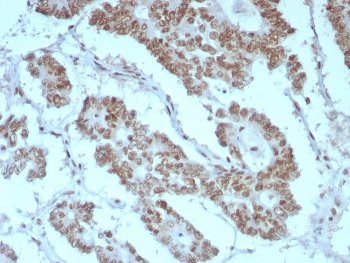 IHC staining of FFPE human prostate tissue with BAF47 antibody (clone rINI1/8850) HIER: boil tissue sections in pH 9 10mM Tris with 1mM EDTA for 20 min and allow to cool before testing.~