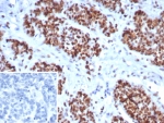 IHC staining of FFPE human ovarian cancer tissue with MSH6 antibody (clone MSH6/8338R). Inset: PBS used in place of primary Ab (secondary Ab negative control). HIER: boil tissue sections in pH 9 10mM Tris with 1mM EDTA for 20 min and allow to cool before testing.