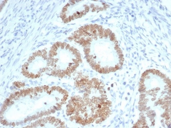 IHC staining of FFPE human colon carcinoma tissue with SATB2 antibody (clone SATB2/7110). Strong nuclear staining is observed at 2ug/ml. HIER: boil tissue sections in pH 9 10mM Tris with 1mM EDTA for 20 min and allow to cool before testing.~