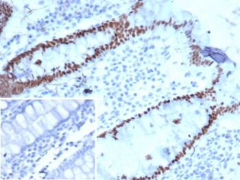 IHC staining of FFPE human colon carcinoma tissue with SATB2 antibody. Strong nuclear staining is observed using clone SATB2/7112 at 2ug/ml. Inset: PBS used in place of primary Ab (secondary Ab negative control). HIER: boil tissue sections in pH 9 10mM Tris with 1mM EDTA for 20 min and allow to cool before te