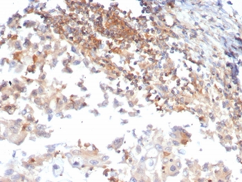 IHC staining of FFPE human ovarian carcinoma tissue with Luteinizing Hormone Receptor antibody (clone LHCGR/7399). HIER: boil tissue sections in pH 9 10mM Tris with 1mM EDTA for 20 min and allow to cool before testing.~